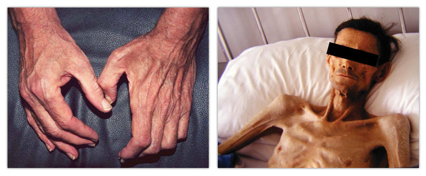 High age often results in loss of muscle mass (sarcopenia) as illustrated in this image. Cancer is also often associated with loss of muscle mass (cancer cachexia) resulting in pronounced weakness and ultimately in death